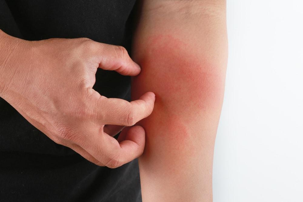 Atopowe zapalenie skóry – choroba XXI wieku?