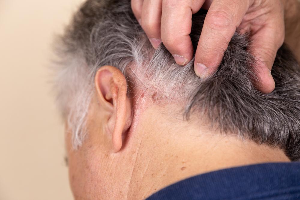 Atopowe zapalenie skóry głowy – jakie wprowadzić leczenie skóry głowy?