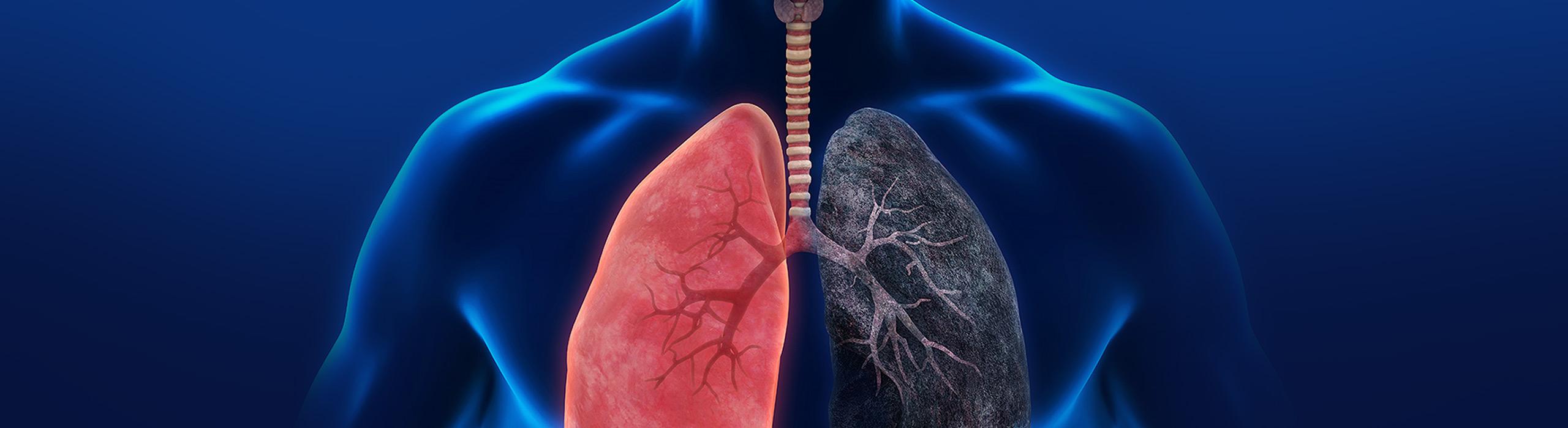 Przewlekła Obturacyjna Choroba Płuc (POChP)